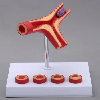 Модель сердечно-сосудистого атеросклероза человека, модель тромбоза сосудов человека, медицинские учебные принадлежности 12